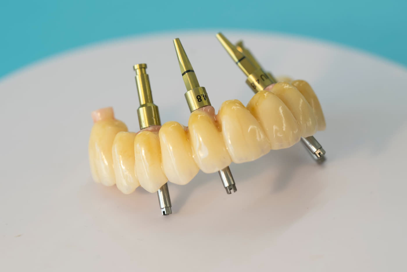 Prothèse sur implant